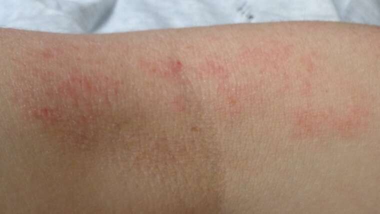 Atopowe zapalenie skóry