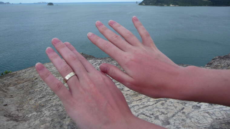 Oparzenia skóry – jak zapobiegać i leczyć?