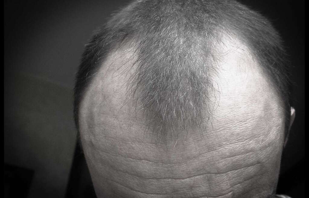 Czy dermatolog leczy łysienie?