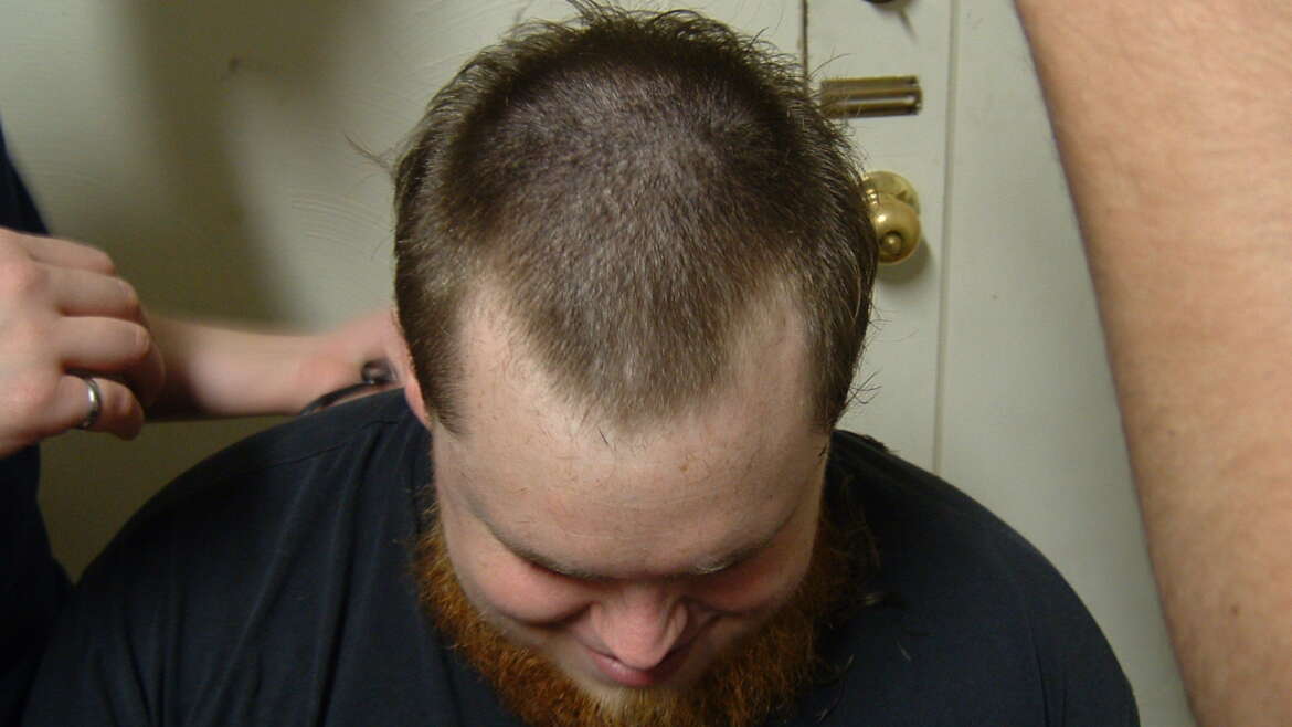 Łysienie androgenowe a dermatologia