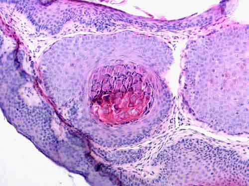 Mięczak zakaźny – objawy i leczenie