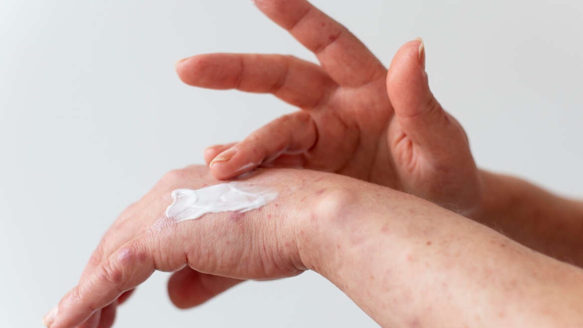 Plamy starcze – jak sobie z nimi radzić?