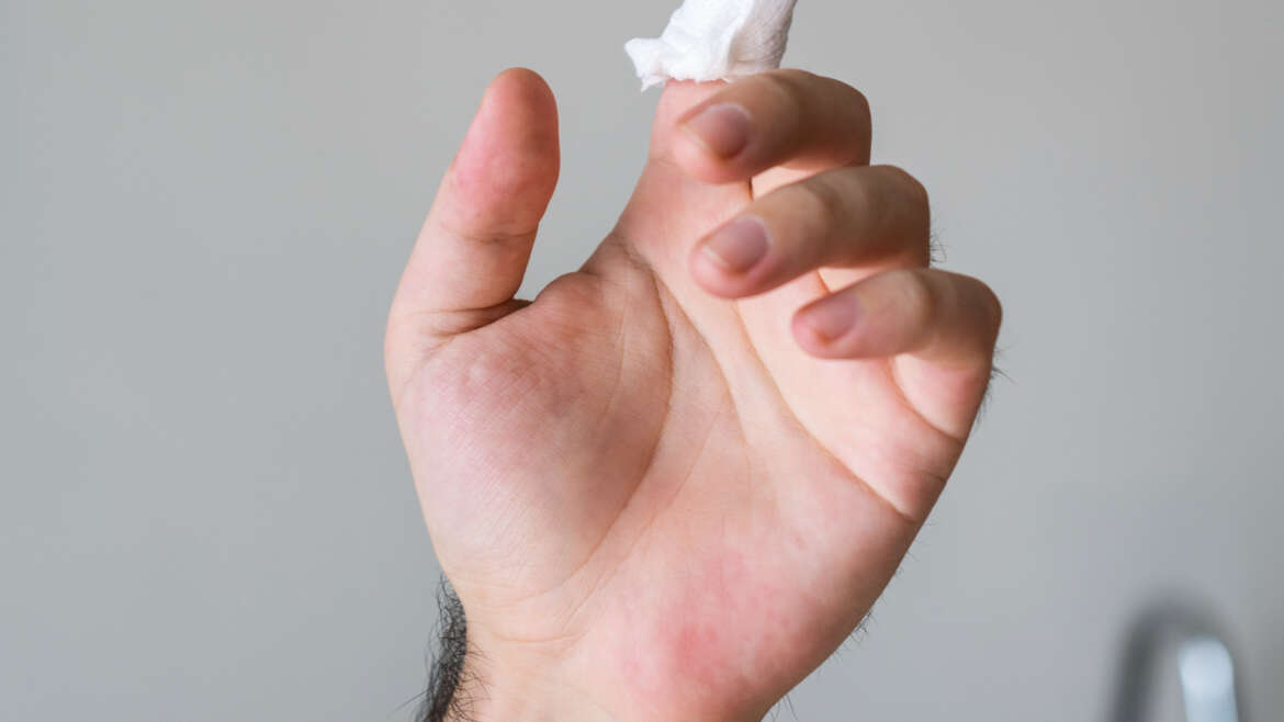 Zastrzał – czym jest, jak powstaje i jak go leczyć?