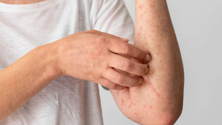 Alergia skórna – jak ją rozpoznać i skutecznie leczyć?